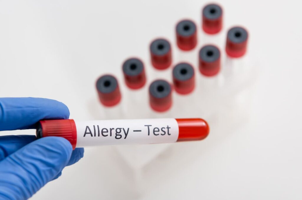 Allergy Tests Service